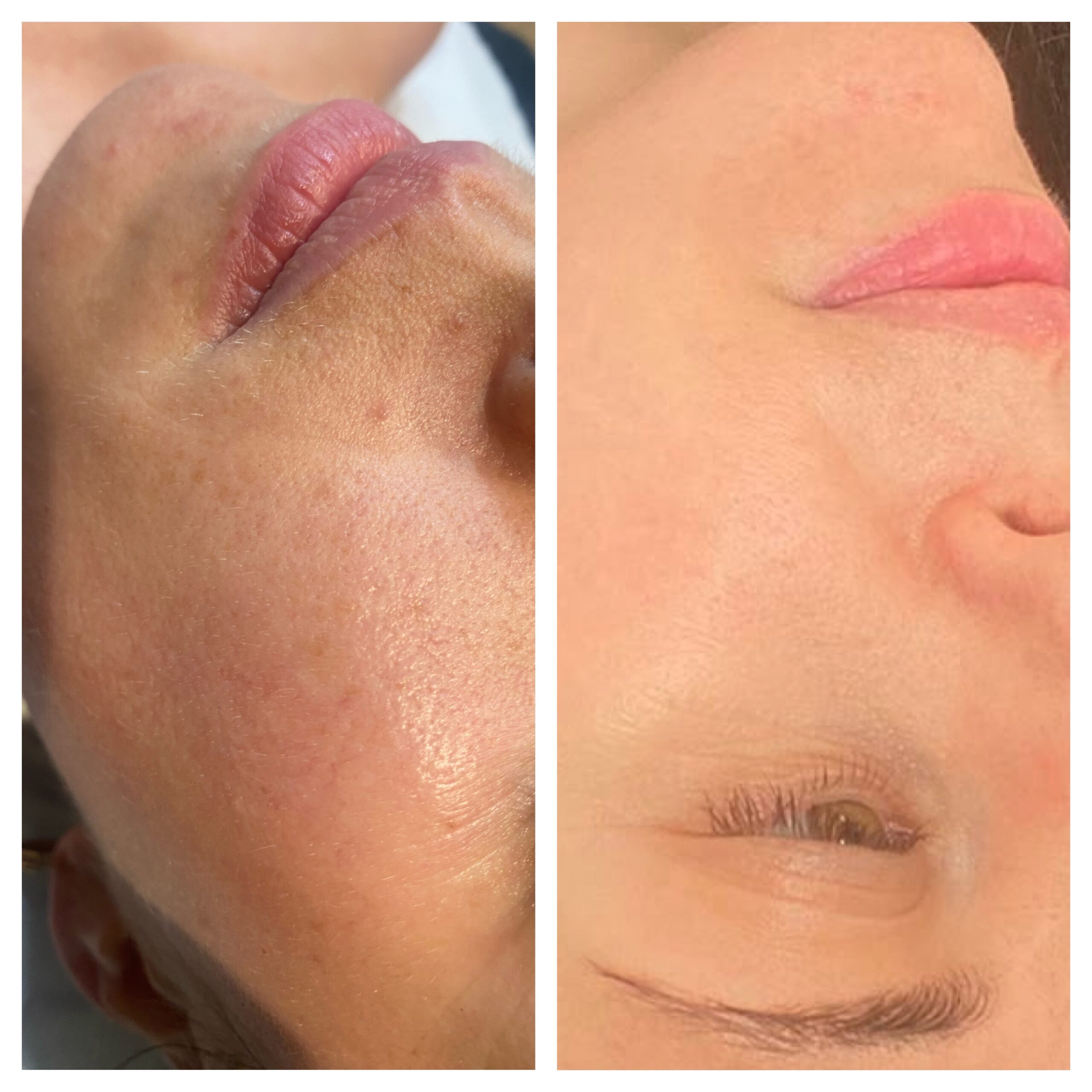 laser hair removal london