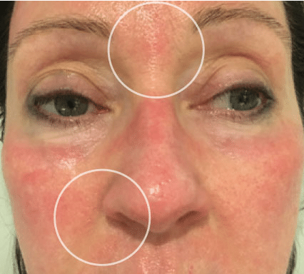 After Needle-Free Mesotherapy Treatment