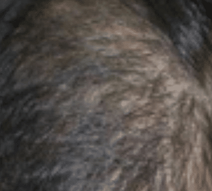 After Needle-Free Mesotherapy