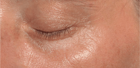After Mesoestetic Eyecon Treatment
