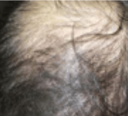 Needle-Free Mesotherapy Before