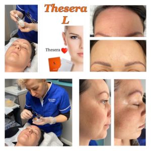 Thesera L No Needle Thread Lift