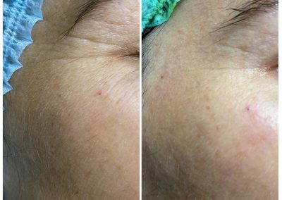 Improvement of Wrinkles from BioRePeel